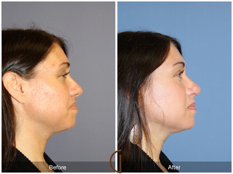 Tip Rhinoplasty Before & After Photo