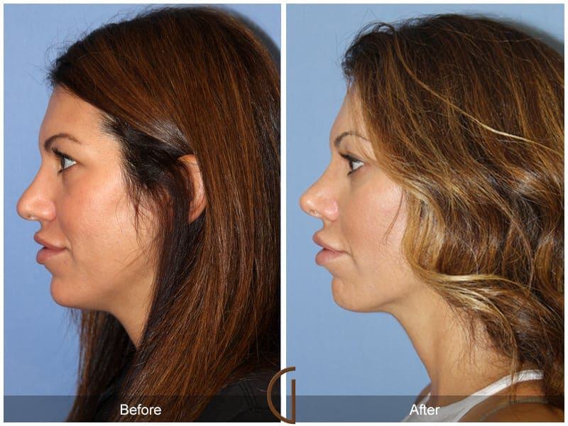 Tip Rhinoplasty Before & After Photo